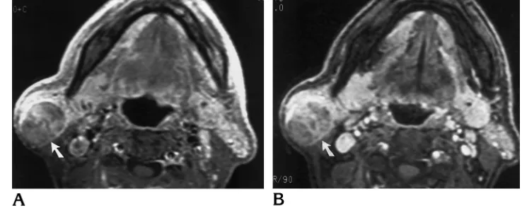 Fig 8. Case 5: Warthin tumor.