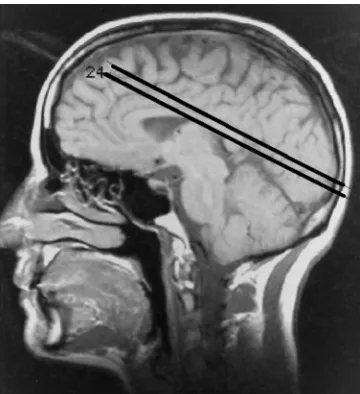 Fig 1. Parasagittal scout view shows positioning of the two