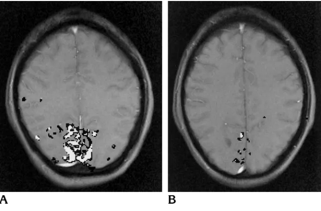 Fig 6. Aibility: the area that is activated in either ofthe two studies is shown inthat is activated in both studies is shown inwhite1477 mm0.50