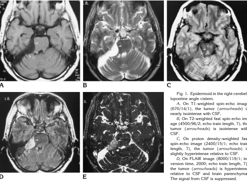 Fig 1. Epidermoid in the right cerebel-