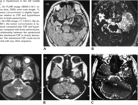 Fig 2. Epidermoid in the left middle