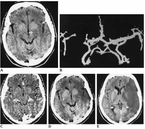 Fig 5. A 69-year-old woman with MCA trunk occlusion.Alentiform nucleus (supply in this case was rated as “good” (angiogram., Baseline CT study 5 hours after symptom onset already shows hypodensity of the left insular cortex and the posterior part of thearr