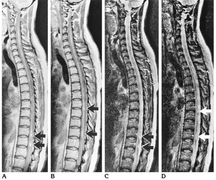 Fig 3. Type II MR finding. Sagittal proton density–weighted (A, Bwith secondary progressive MS show multiple focal lesions (weighted images, the spinal cord appears diffusely involved, including areas in which there are no focal lesions on the correspondin