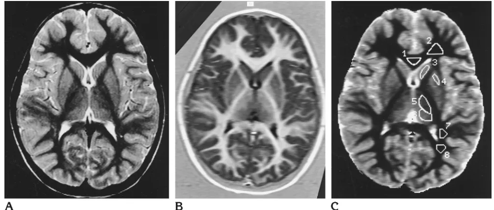 Fig 1. Image set from the youngest volunteer analyzed, a 4-year-old unsedated girl.Afor each effective echo time).is not shown, since 10 to 20 small ROIs must be scattered over the image periphery to obtain an adequate sample size of gray matter5, anterior
