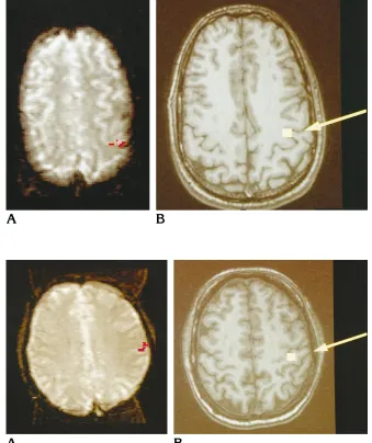 Fig 4. Right index finger stimulation