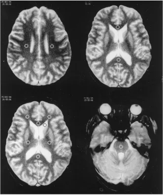 TABLE 1: Magnetization transfer ratio (MTR) values for sites ofHIV encephalitis lesions and normal-appearing white matter in 13HIV-positive patients (group 1)