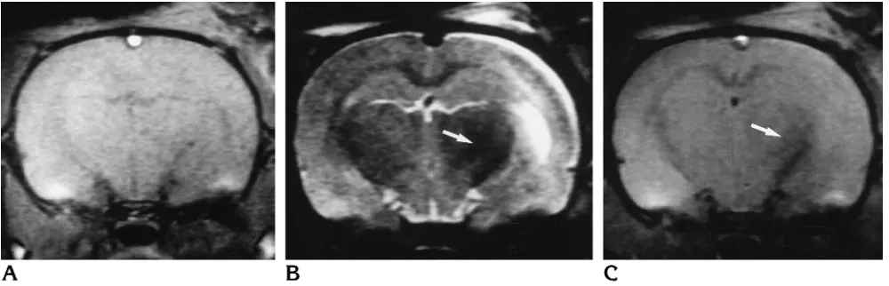 Fig 3. Coronal images of a rat brain 7 days after left MCA occlusion (animal 7).Acapsule also exhibits low signal intensity due to wallerian degeneration