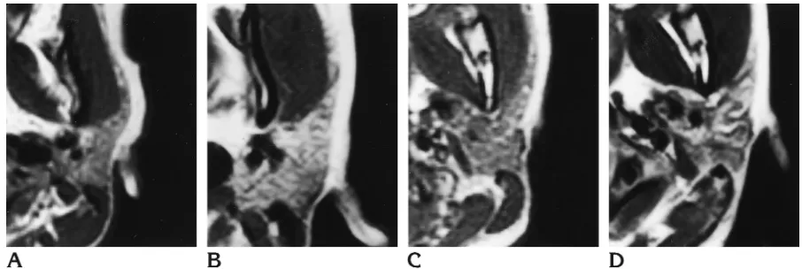 Fig 7. T1-weighted MR (500/20/2) (Ain patient with Sjo¨gren syndrome ( and B) and CT (C and D) features of submandibular glands in healthy subject (A and C) andB and D)