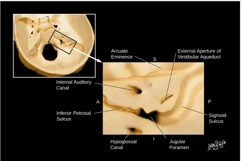 Fig 1. Anatomic landmarks on posterior surface of right petrous bone, viewed through posterior cranial fossa