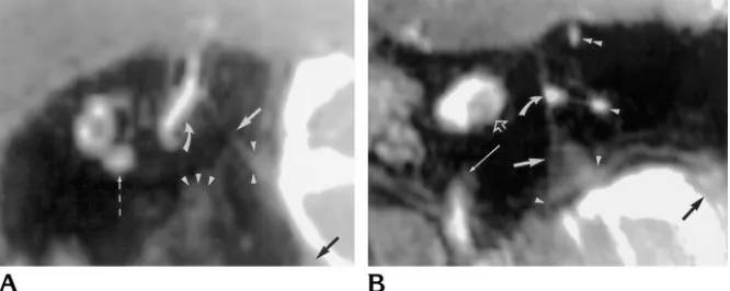 Fig 6. MR images of normal left ES, steady-state gradient-echo sequence, 1-mm sections; Aintraosseous ES (operculum covering the ES from the posterior fossa is unmarked