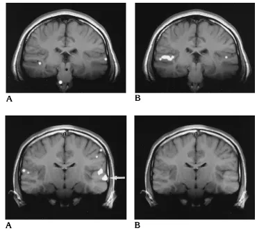 Fig 3. Athrough the TTG shows no detect-able TTG activation in response to,Coronalsectiona 1000-Hz tone at 20 dB SL.