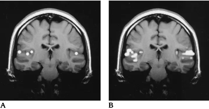 Fig 10. Atained through the TTG after acti-vation with a 1000-Hz pure tonedelivered at 50 dB SL