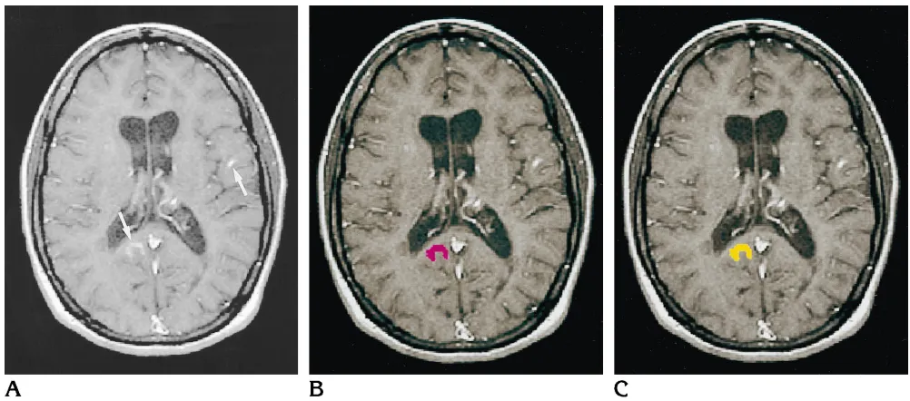 Fig 1. A, Contrast-enhanced T1-weighted MR image shows enhancing MS lesions (arrows).B, During the verification step, the software shows potential lesions one by one (in red) to the operator.C, After a “yes” response from the operator, the software changes the color of the lesion display (to yellow) to confirm acceptanceof the potential lesion as a true lesion.