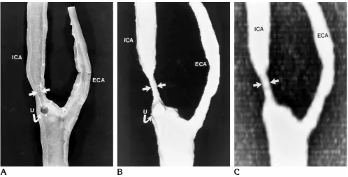 Fig 1. Aarrowdepicted. The common carotid artery is not labeled. A small ulcer (stenosis