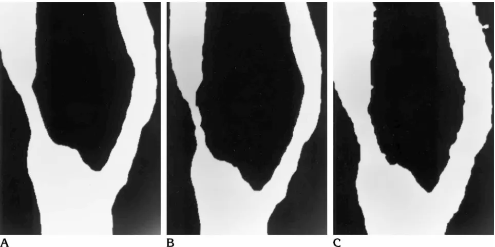 Fig 3. Maximum intensity projection images with various level settings but with window setting held constant.A, Optimal level setting, halfway between luminal and vessel wall densities.B, Level setting of 40 HU above that of A shows artifactual decrease in residual ICA luminal diameter.C, Level setting 40 HU below that of A shows artifactual increase in residual ICA diameter.