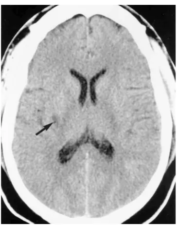 Fig 1. Focal arterial infarction on CT. Axial noncontrast CT