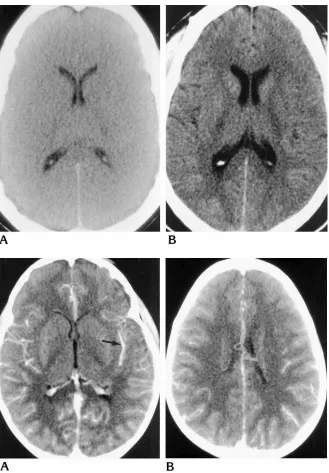 Fig 2. Cerebral edema.Acerebral edema with sulcal effacement andloss of density differences between grayand white matter., Noncontrast CT scan shows diffuseB, CT scan obtained 1 week later shows