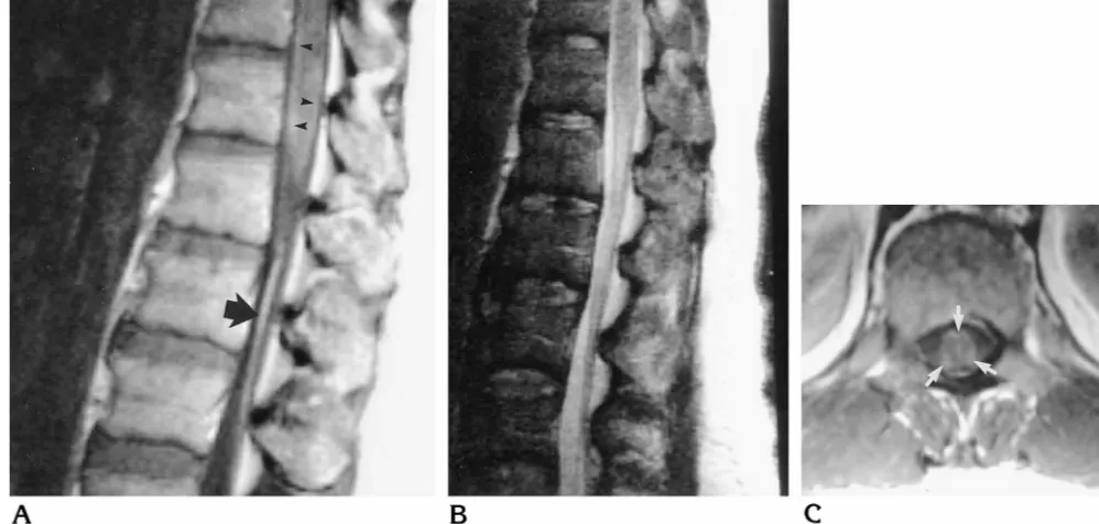 Fig 6. Abnormal enhancement of the distal spinal cord, conus medullaris, and cauda equina., Axial postcontrast T1-weighted MR image shows abnormal enhancement (Analysis of cerebrospinal fluid showed lymphocytosis and elevated proteins