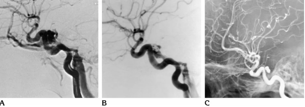 Fig 1. Case 1. Lateral subtraction angiogram of the ipsilateral internal carotid artery (Aocclusion of the fistula is seen after detachment of four GDCs (in the internal carotid artery and the coil had to be withdrawn without detachment