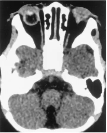 Fig 3. Case3:agenesis of the corpus callosum.Anophthalmosand, Axial T1-weighted (500/15/2) MR