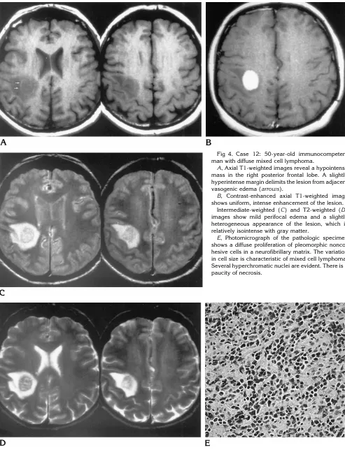 Fig 4. Case 12: 50-year-old immunocompetent