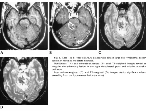 Fig 6. Case 17: 31-year-old AIDS patient with diffuse large cell lymphoma. Biopsy