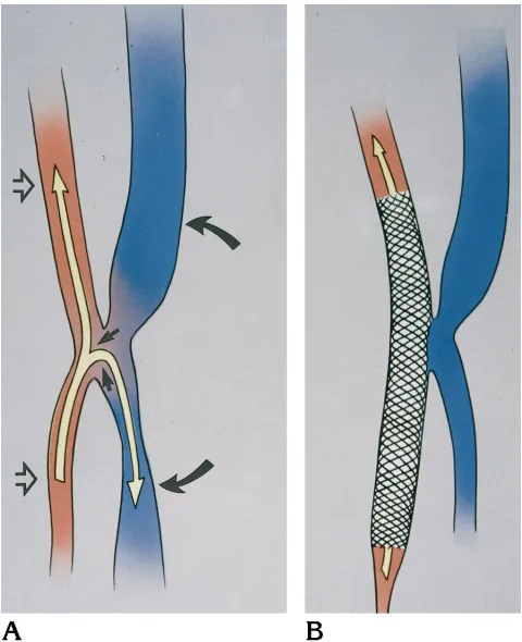 Fig 3. Grosslongitudinalsection through the stent containing a seg-ment of the carotid artery