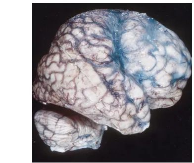 Fig 3. Diffuse polymicrogyria.A(4000/90/1) in a newborn with dif-fuse polymicrogyria shows incom-plete sulcation throughout the brain,multiple areas of thick cortex (par-ticularly in the right hemisphere),and a close-lip schizencephaly (rowheadstal region