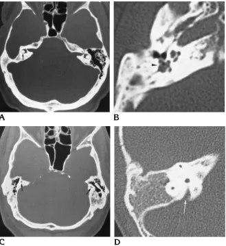 Fig 13. Axial CT scans of labyrinthine