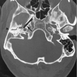 Fig 5. Vessel canal aberrations.Afirst-degree auricular dysplasia.temporal bone., Axial CT scan at the level of the foramen lacerum and basal turn of the cochlea shows hypoplastic carotid canal (arrow) inB, Axial CT scan shows dehiscent sigmoid sinus (arrow) and an emissary (arrowhead) in a severely microtic ear with hypoplasticC, Sagittal CT scan in the plane of the round window shows high-riding jugular bulb.