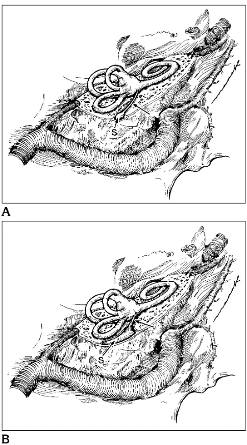 Fig 1. Aduct from its internal aperture in the anteromedial wall of thevestibule to the endolymphatic sac (from above and behind the temporal bone