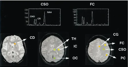 Fig 2. Representative spectra from white and gray matter and location of ROIs in one subject