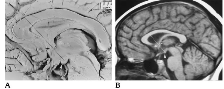 Fig 1. Photograph of the me-dial surface of an adult human ce-
