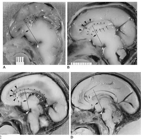 Fig 4. Photographs of the medial surface of brains of human fetal specimens show the growth of the corpus callosum.Acallosal sulcus ((The cingulate gyrus (toward the future subcallosal area.(small arrowheadssmall arrowheadsB, In a 12-week-old specimen, a r