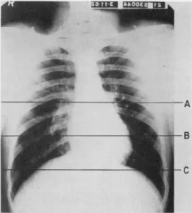 Figure 8 shows some of the electrocardiograms re- re-corded from this subject, and scalar derivations from his vectorcardiogram corresponding to  approxi-mately the same area