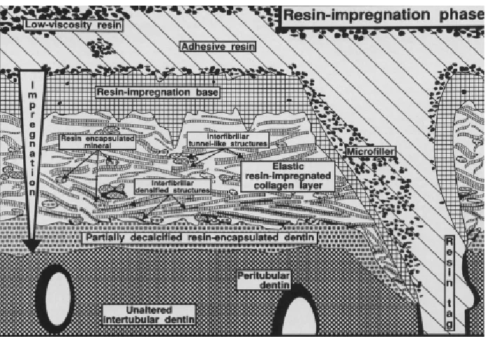 Figure 2: Schematic representation explaining the ultrastructure of the resin-dentin interdiffusion zone at the resin 