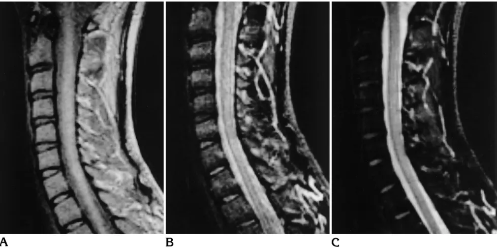 Fig 3. Superiority of T2-weighted spin-echo over MT-GE. The cervical spinal cord shows diffuse signal hyperintensity on both the