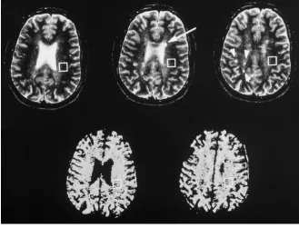 TABLE 2: Magnetization transfer ratio (MTR) and signal intensity on T2-weighted MR images