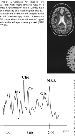 Fig 5. T2-weighted MR images (toprowdiffuse hyperintensity lesion. Diffuse highsignal intensity and focal brighter area (rowheadthe MR spectroscopy voxel