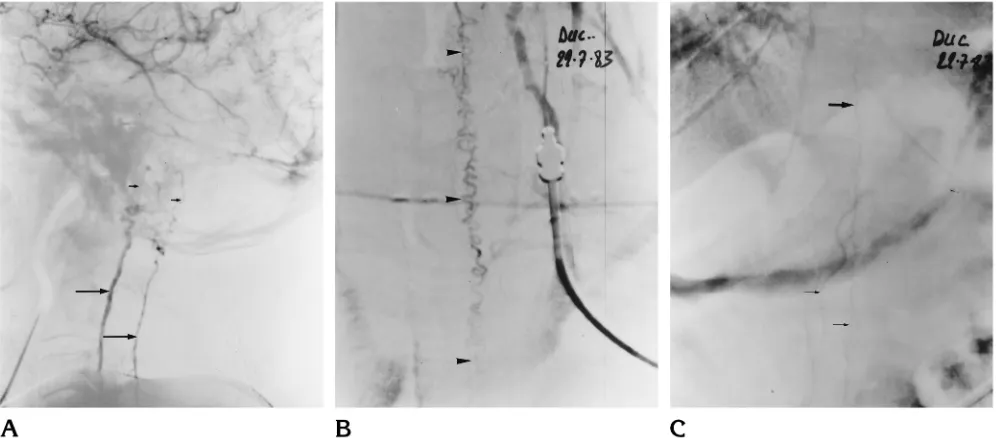 Fig 2. Left common carotid artery angiograms in a 53-year-old man with a progressive ascending myelopathy leading to tetraplegia.Apontomesencephalic veins ((perimedullary veins (arrowheads, Lateral view shows a DAVF of the tentorium cerebelli draining into