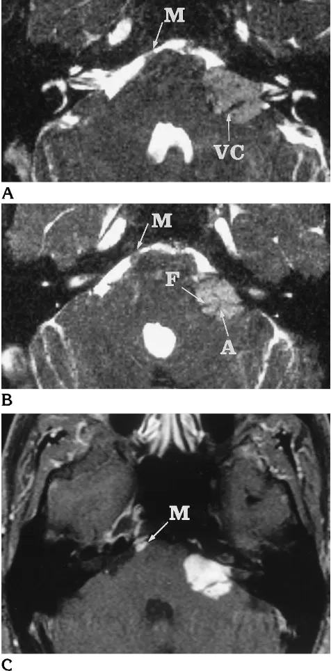 Fig 3. Subarachnoid metastatic ependymoma, a possible false-