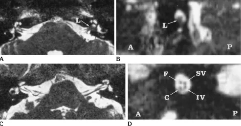 Fig 5. Axial reconstruction CISS MR image in a patient with