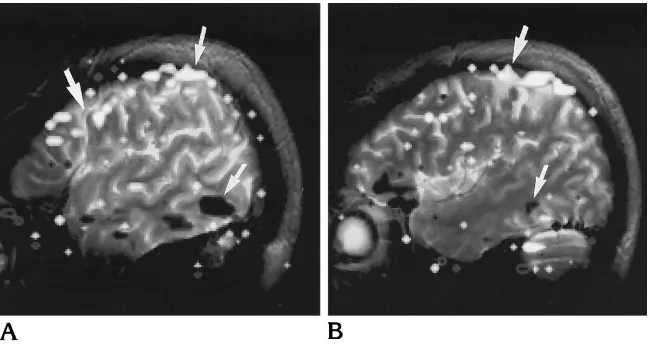Fig 3. Two contiguous functional im-ages in a sagittal plane of a volunteer who