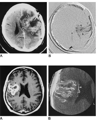 Fig 2. Case 3: 51-year-old man withresidual grade IV astrocytoma after sur-