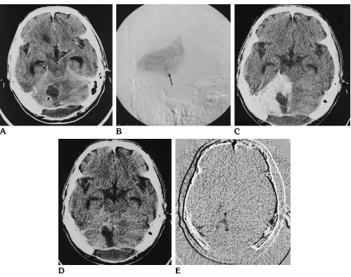 Fig 4. Case 4: 52-year-old man with grade III astrocytoma in the cerebellar vermis.Conventional contrast-enhanced CT scan (cerebellar hemisphere and the vermis