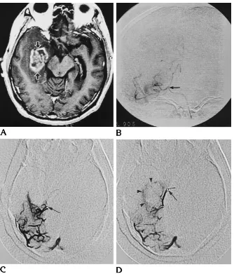 Fig 5. Case 10: 46-year-old man withgrade II astrocytoma.