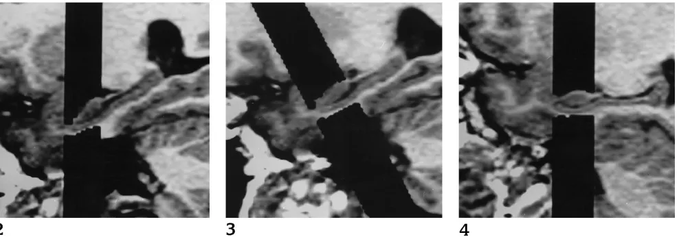 Fig 2. Image processing, right hippo-campus in healthy volunteer: hippocampal
