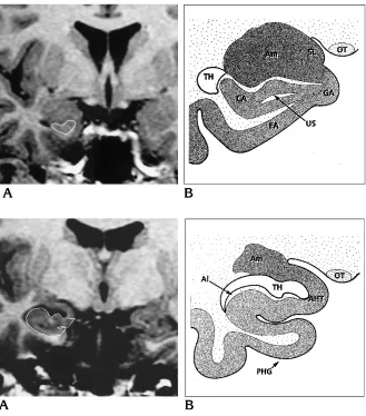 Fig 6. Aage (PERP protocol) shows the landmarksof the rostral part of the hippocampalhead., Spoiled GRASS coronal im-, Anatomic drawing at the same level