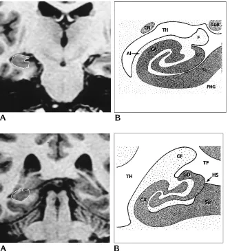 Fig 8. Aage (PERP protocol) shows the landmarksof the hippocampal body.B, Spoiled GRASS coronal im-, Anatomic drawing at the same level.