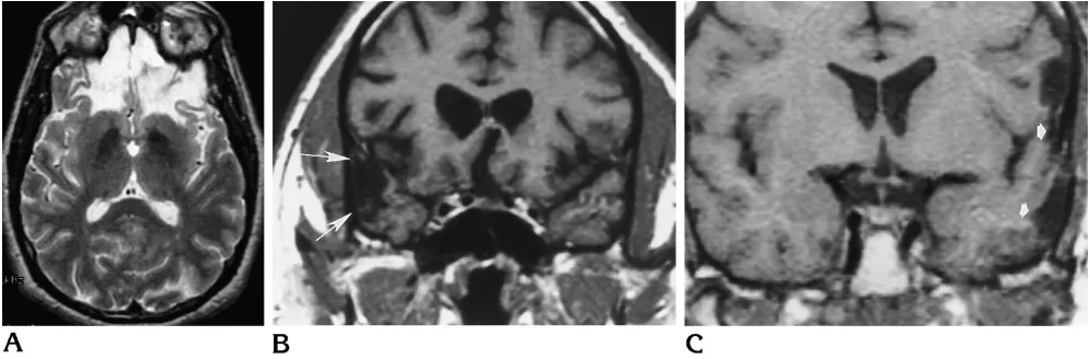 Fig 3. Cortical damage in three patients.Ascores was noted.anosmic and also had olfactory bulb and tract injury.C, Unilateral temporal lobe damage (, Axial T2-weighted MR image shows bifrontal encephalomalacic change, which was symmetric in severity